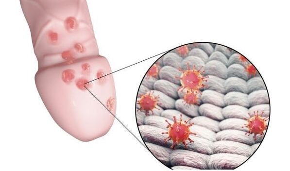alergia na gél na zväčšenie penisu