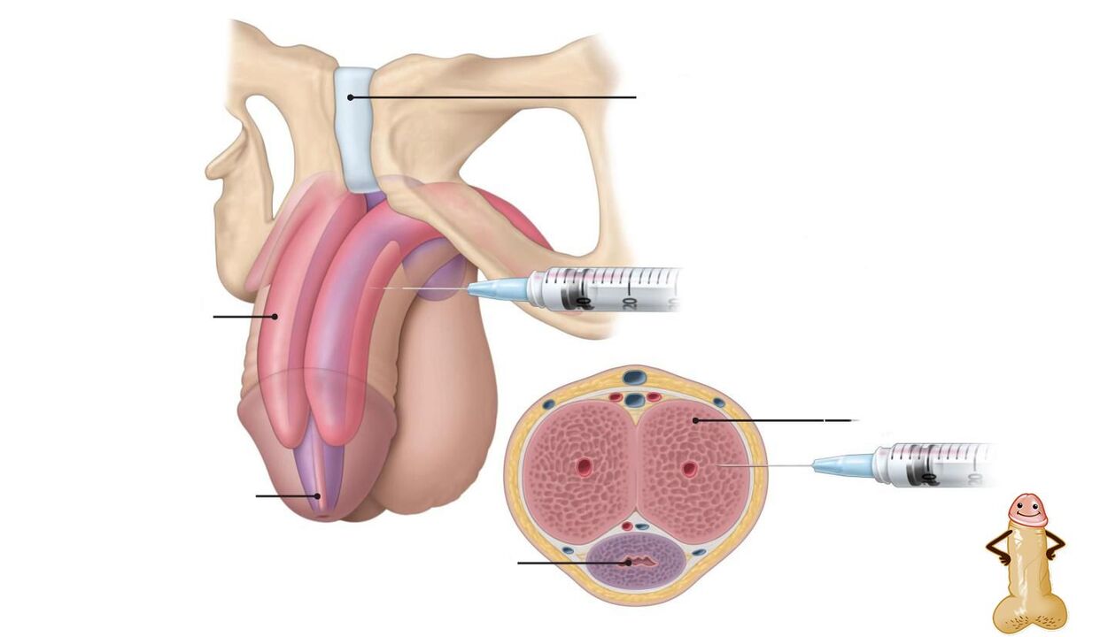 injekcie kyseliny hyalurónovej na zväčšenie penisu